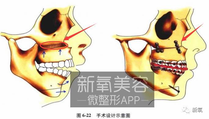 林允倪妮舒淇这类鲶鱼脸其实是种面部发育缺陷