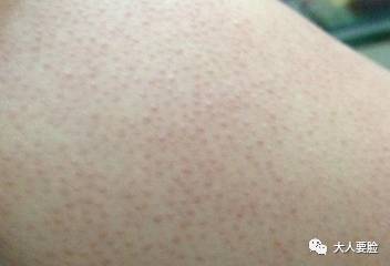 杨幂没P的腿上竟然有鸡皮肤?