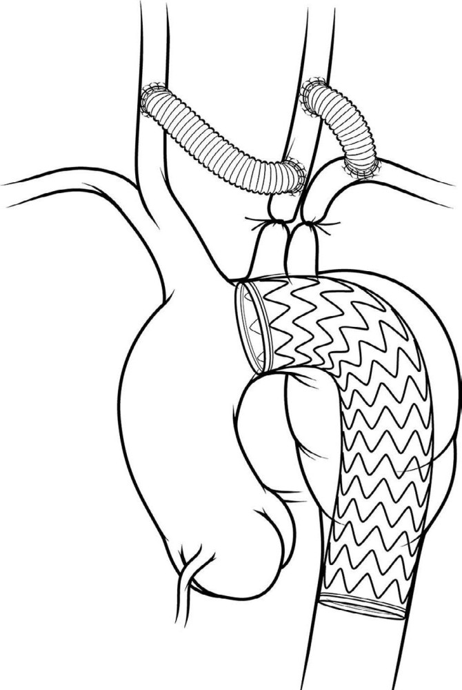 图说全主动脉弓de微创重建技术