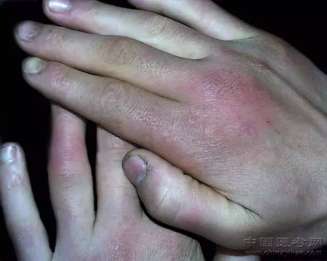 221种皮肤病图谱