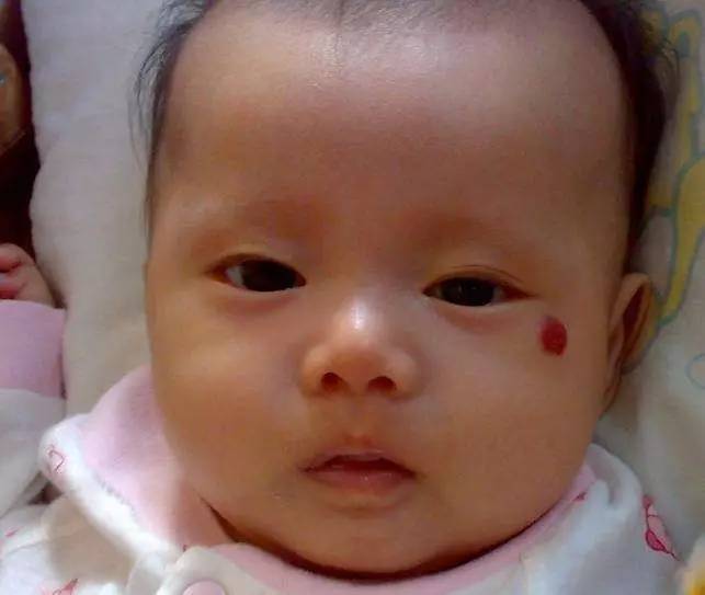 如何识别红胎记和婴儿血管瘤?