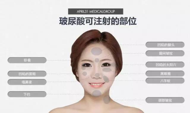 肉毒素,爱美的女人离不了-看点快报