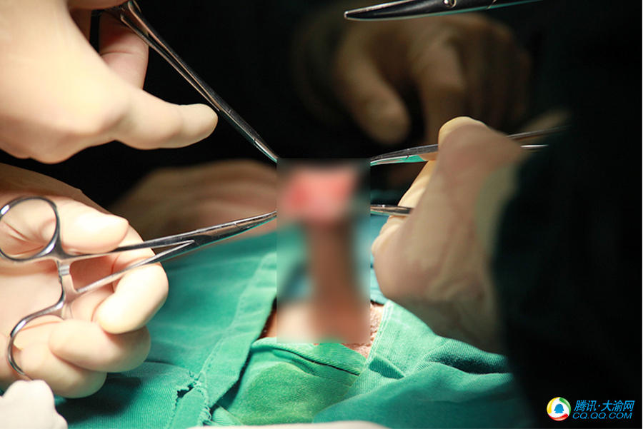 包皮环切 90%的重庆男孩都该