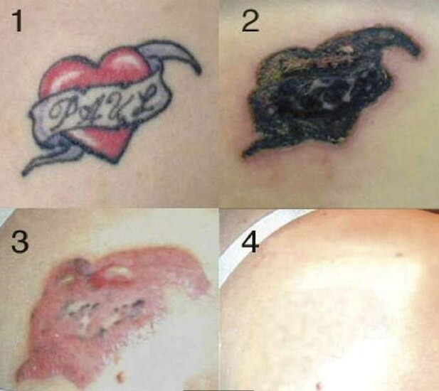 激光去除的纹身哪去了?知道后不敢纹身