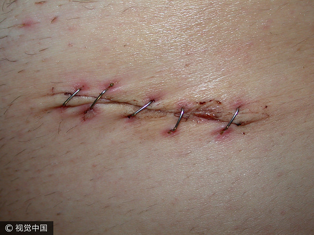 8年的阑尾炎手术疤痕该怎样治疗?