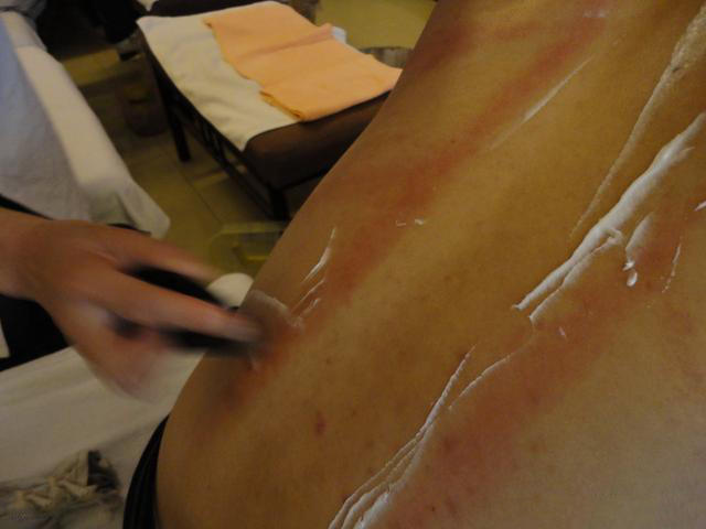 湿气重该不该拔火罐?广西男子拔火罐拔出7个