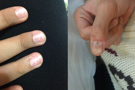 手指甲凹凸不平有横沟,一定要知道的健康信号