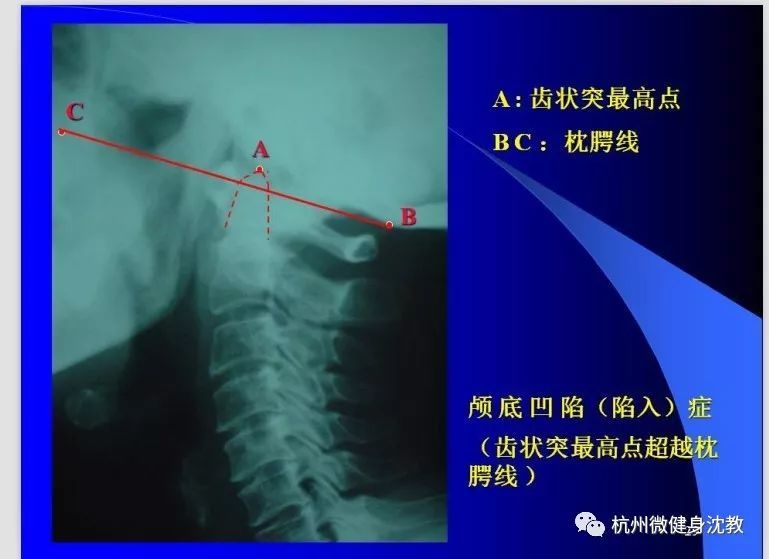 颈椎x片怎么看?这里教你看