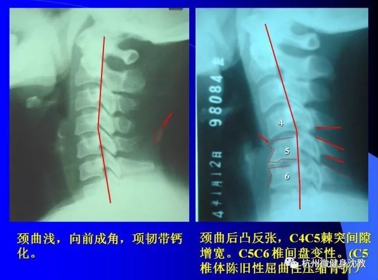 颈椎x片怎么看?这里教你看