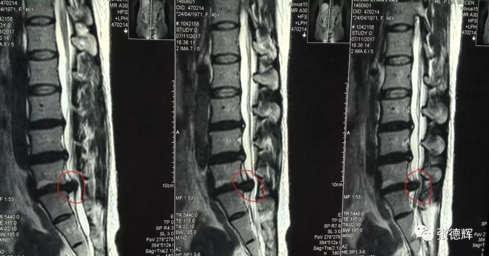 腰5-骶1巨大脱出的微创内镜手术