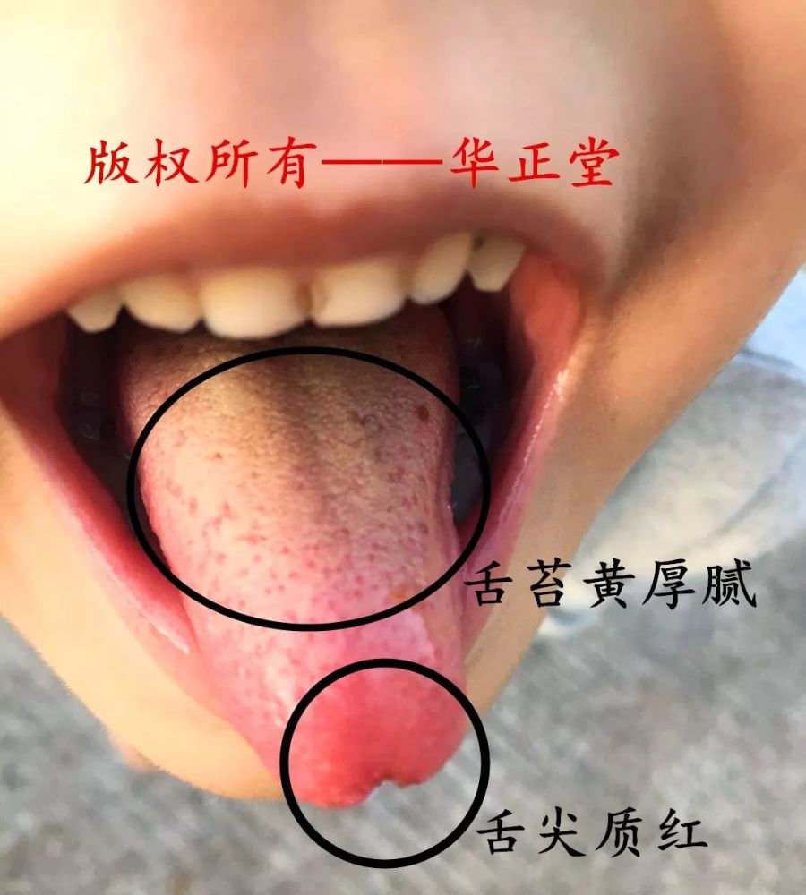 5, 望舌(苔)较为复杂点,在舌诊案例中分享详细内容.