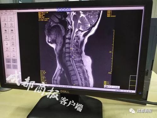 22岁小伙诱因长期熬夜兴奋 突发脑出血昏迷送