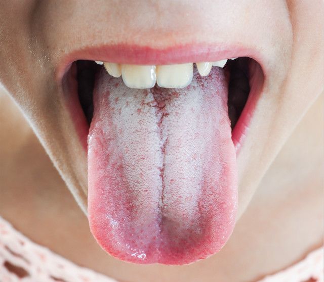 舌头发白怎么回事?舌头颜色的变化可能预示这8种疾病
