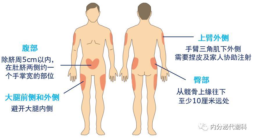 大腿:应选择前面或外侧面进行注射,不要选择大腿内侧,避免刺伤血管和