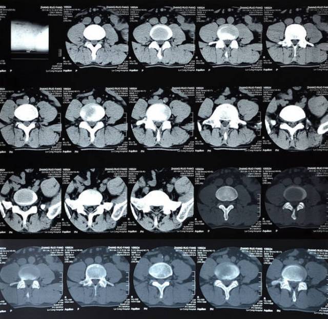 腰间盘突出让做x光又让做ct最后还要做核磁共
