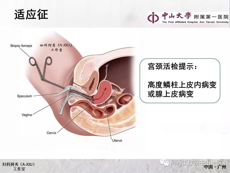 宫颈冷刀锥切手术步骤及sturmdorf缝合法