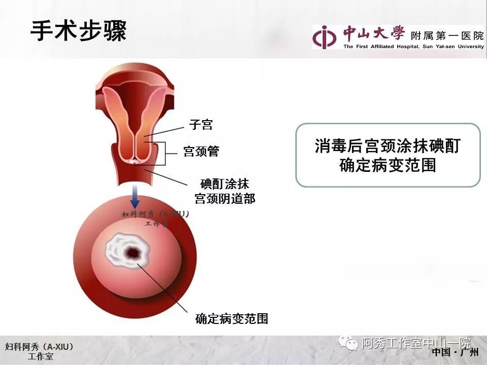 宫颈冷刀锥切手术步骤及sturmdorf缝合法