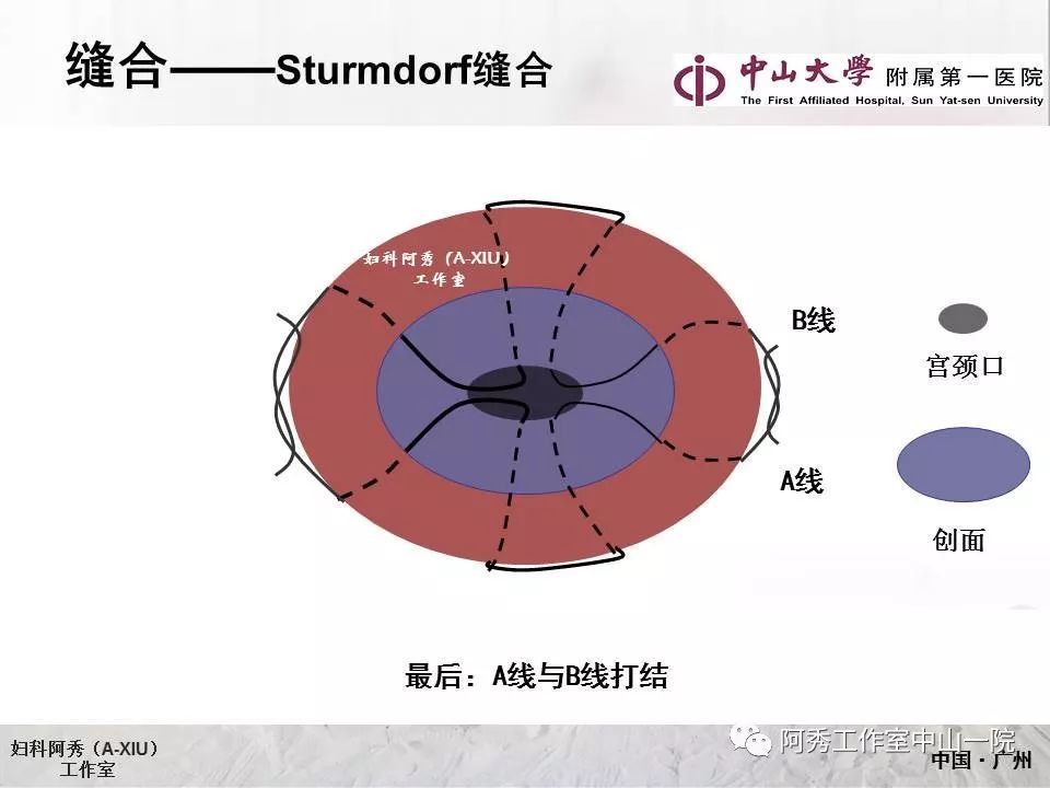 宫颈冷刀锥切手术步骤及sturmdorf缝合法