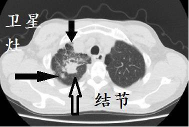 12个病人的肺ct图像详细解读