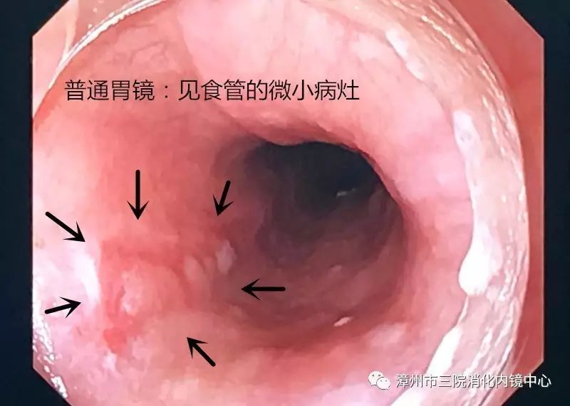 (图1 普通胃镜:见食管的微小糜烂)