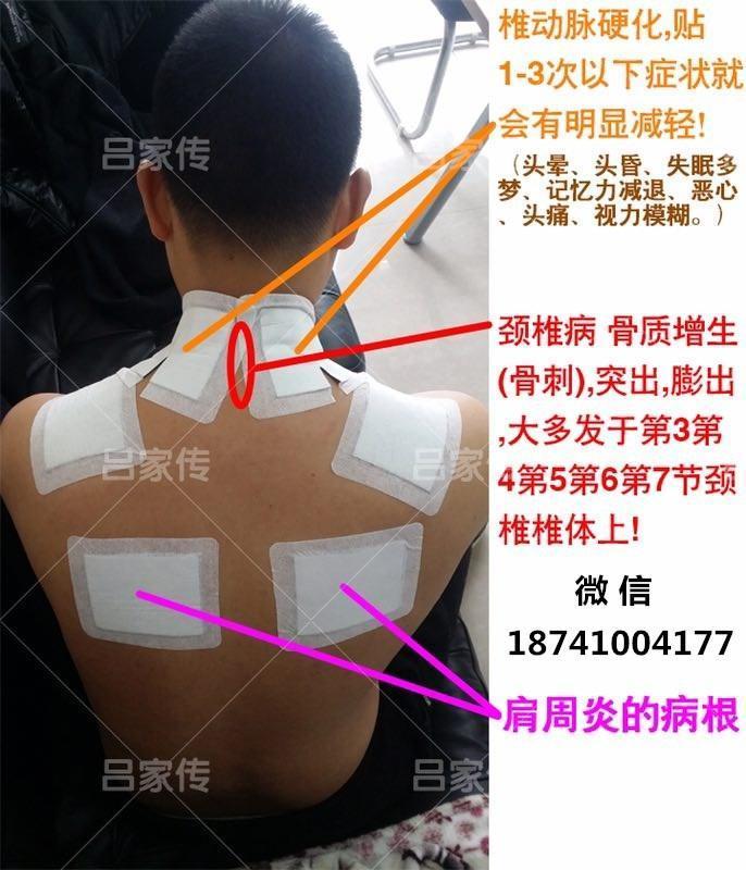 颈椎病,如何才能不再加重?让吕家传膏药吕家传冷敷贴告诉你