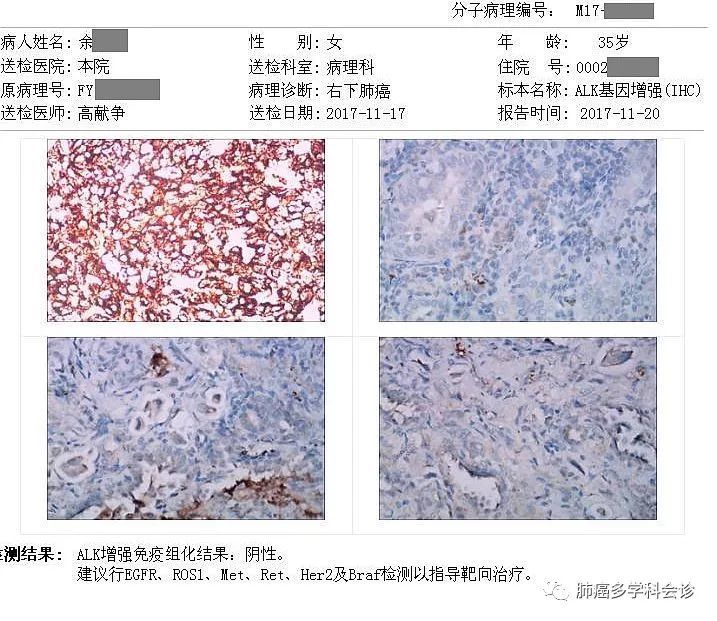 微乳头型肺腺癌有什么特殊的临床表现?