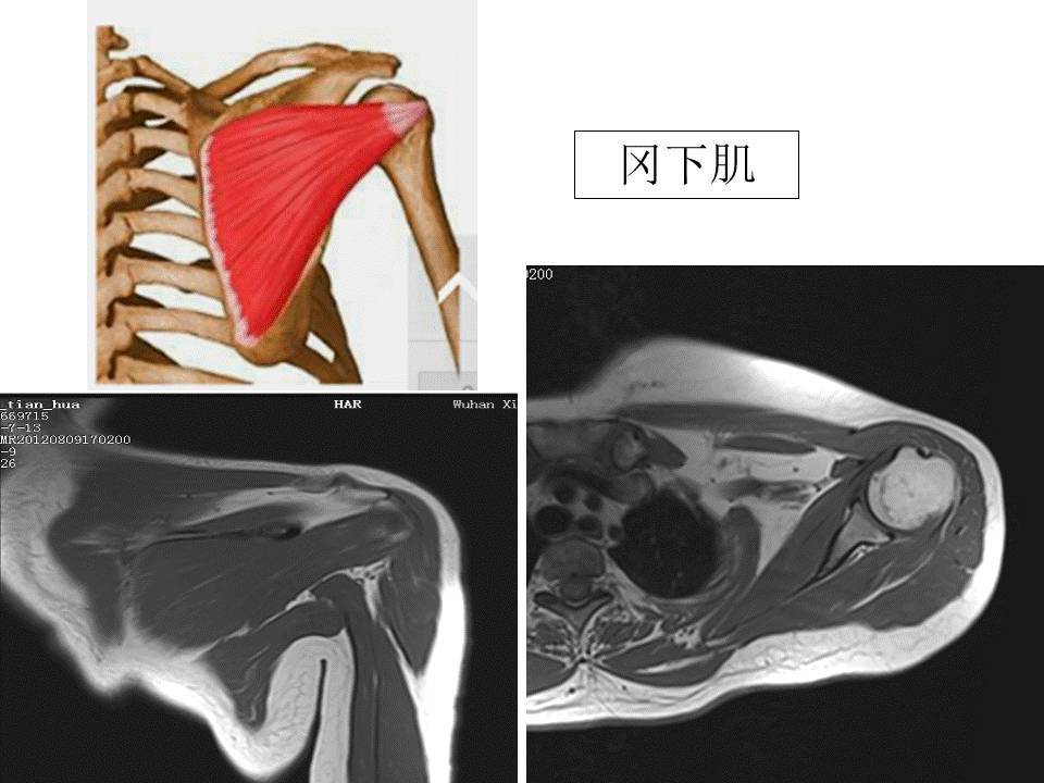 肩袖病变主要包括肌腱炎伴/不伴有钙化的退行性改变以及肌腱撕裂