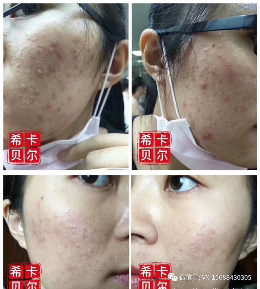 痘痘肌痘印用什么面膜可以根治去除?法国希卡