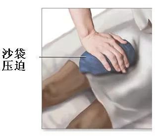 反复咯血?别担心!支气管动脉栓塞术来助力