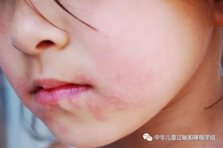 口腔过敏综合征