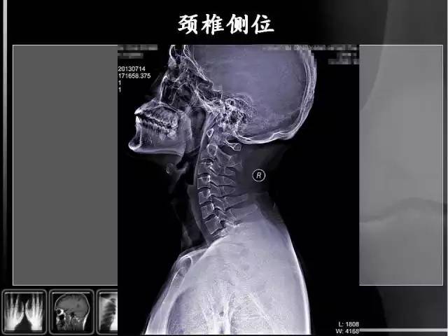 颈椎x线片如何看明白?