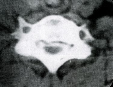 颈椎间盘突出的临床表现及影像诊断,非常详细