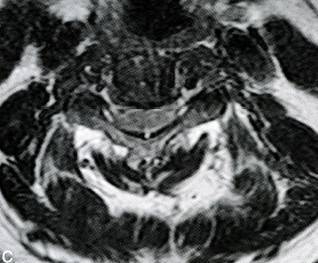 颈椎间盘突出的临床表现及影像诊断,非常详细