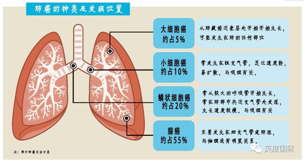 小细胞肺癌系属肺癌四大细胞型态(腺癌,鳞状上皮癌,大细胞癌,小细胞