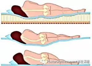睡觉会导致脊柱侧弯?以侧弯的脊柱该怎么预防