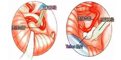 脸疼?牙疼?三叉神经痛?该怎么办?-天天快报
