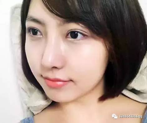 上海天大整形美容医院刘先超医生做的硅胶隆鼻