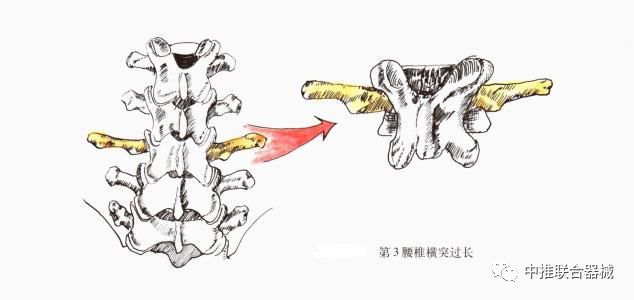 穿刺埋线治疗第三腰椎横突综合征