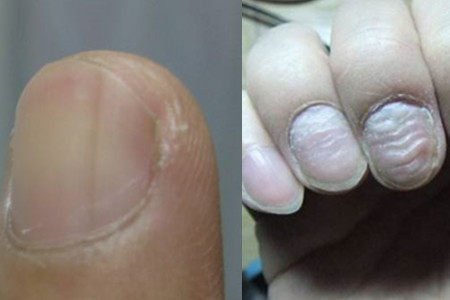 手指甲凹凸不平是怎么回事 一分钟健康小知识