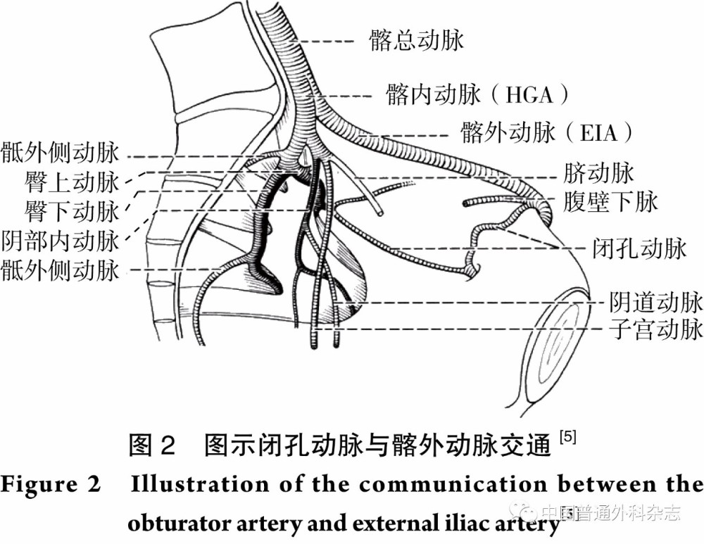 腹主动脉瘤腔内修复术中髂内动脉的疏与堵