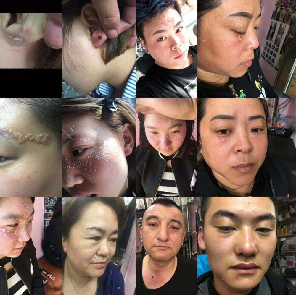 瘊子痦子痣的区别图片
