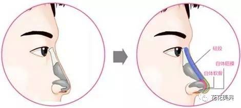 深度解剖鼻子类型,测试你属于哪种鼻型?