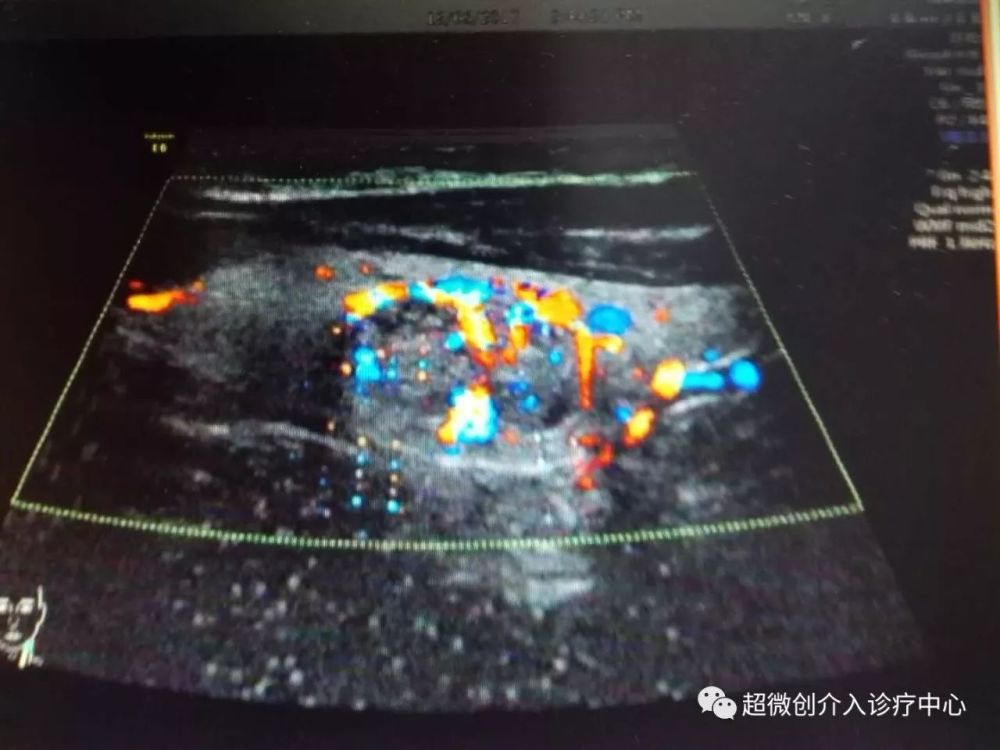 甲状腺结节微波消融术-针尖上的艺术,微创唯美
