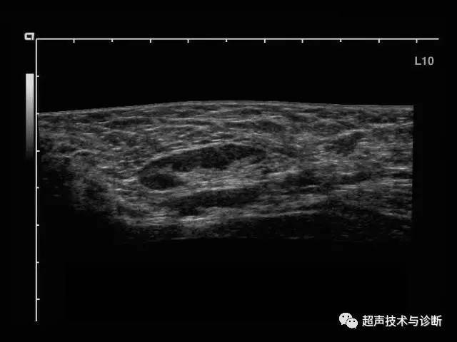 l良,恶性浅表淋巴结的超声鉴别要点