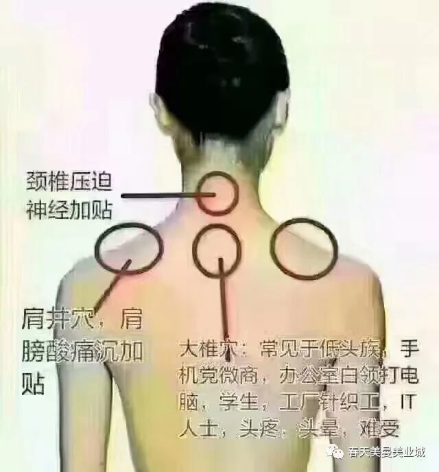 别把颈椎病和富贵包不当一回事儿