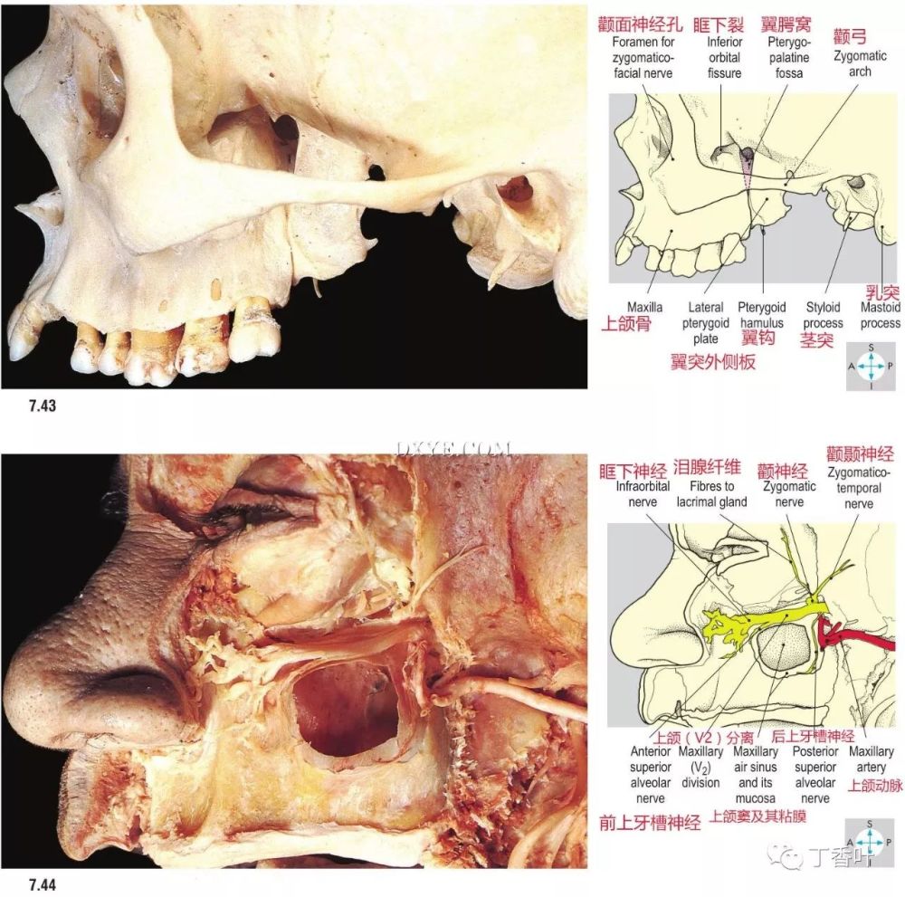 7.44 上颌神经和动脉在眶壁和上颌窦外侧壁切除后可见.