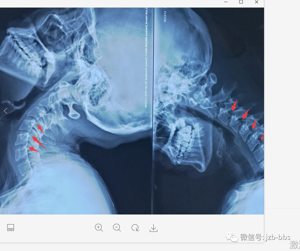 过伸过屈位34  45  56明显不稳,椎动脉本身及周围有丰富的交感神经