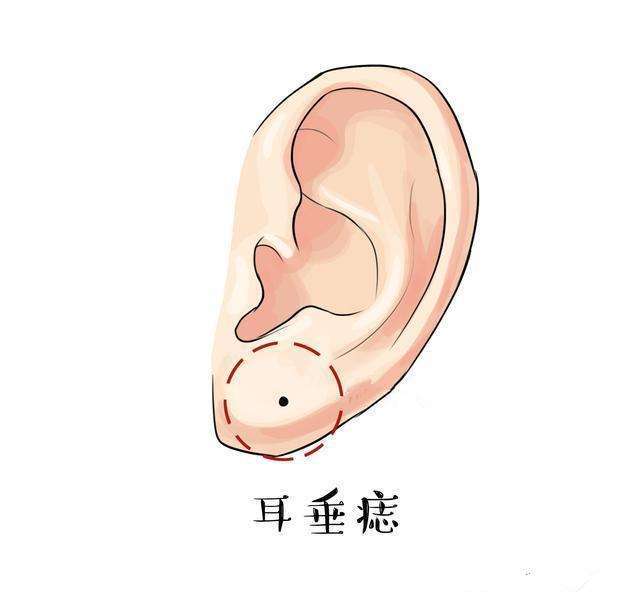 耳朵上的三颗财运痣,你知道在哪吗?
