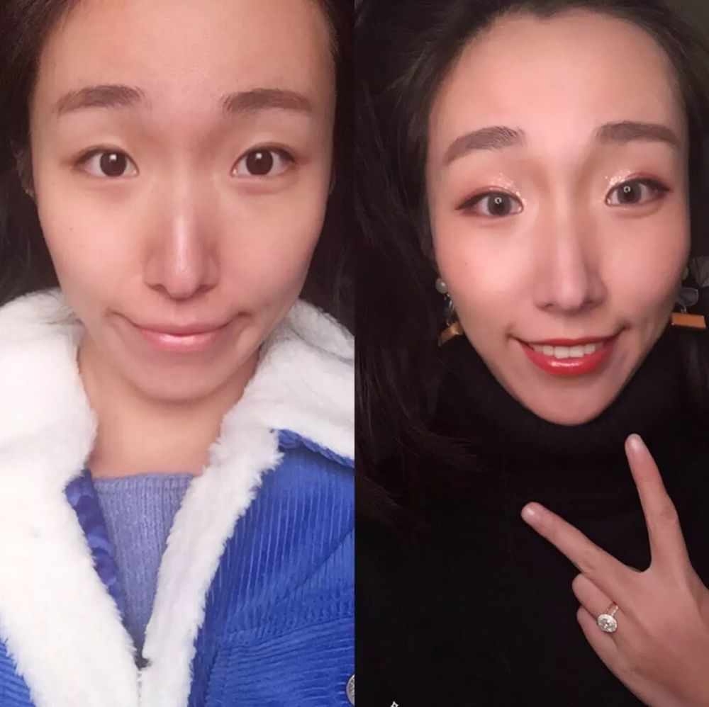 拔智齿可以瘦脸吗?亲测