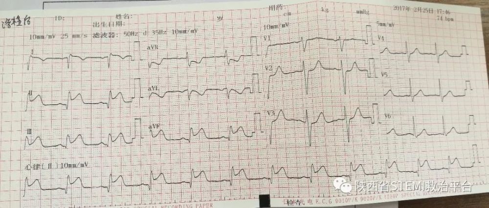 陇县人民医院下壁心梗溶栓一例